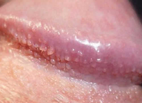 Nốt sùi li ti màu trắng